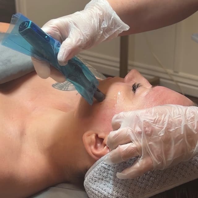 Microneedling at FabWithTabb in Springfield, MO
